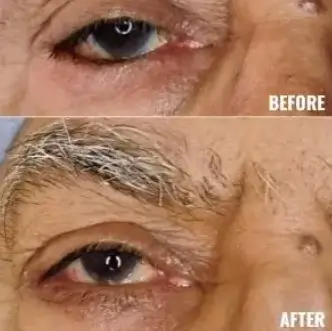 Oculoplasic Surgery At Save Sight Centre