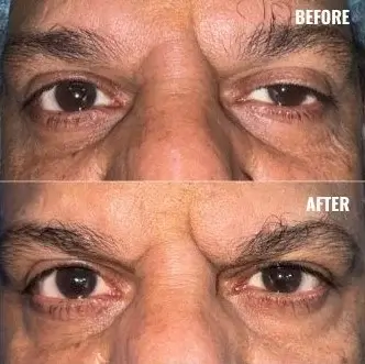 Oculoplasic Surgery At Save Sight Centre