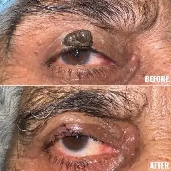 Oculoplasic Surgery At Save Sight Centre
