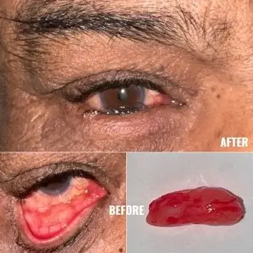 Oculoplasic Surgery At Save Sight Centre
