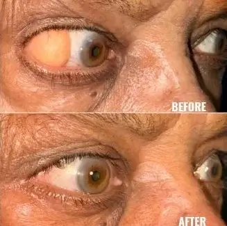 Oculoplasic Surgery At Save Sight Centre
