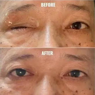 Oculoplasic Surgery At Save Sight Centre