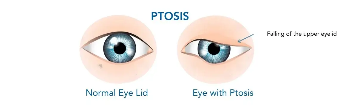 Ptosis Correction Surgery