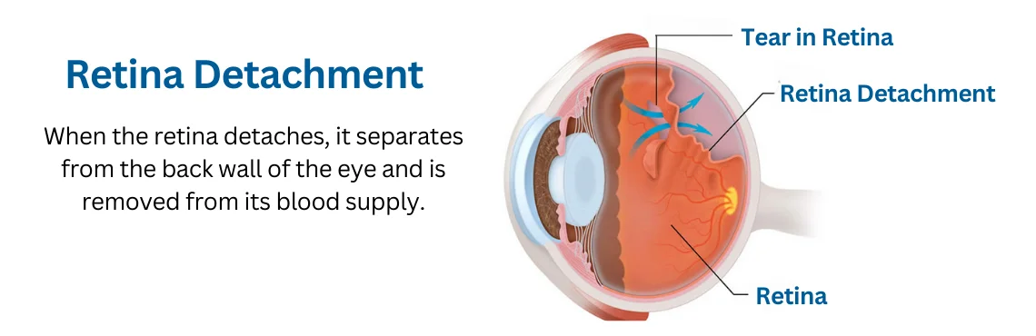 Retinal Detachments