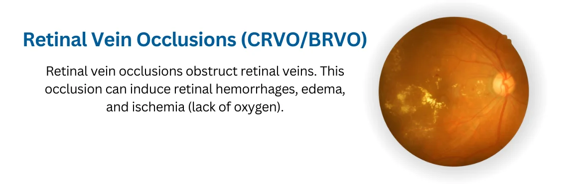 Retinal Vein Occlusions (CRVO/BRVO)
