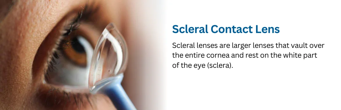 Scleral Contact Lens