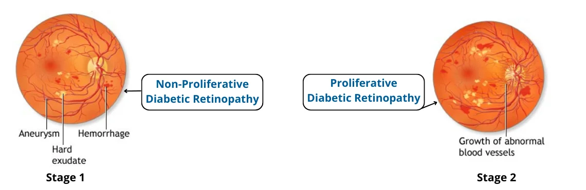 Stages of Diabetic Retinopathy