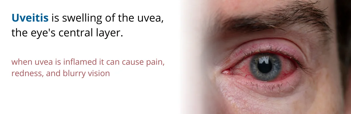 Uveitis Treatment in Delhi