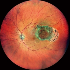 FFA and ICG Eye Test