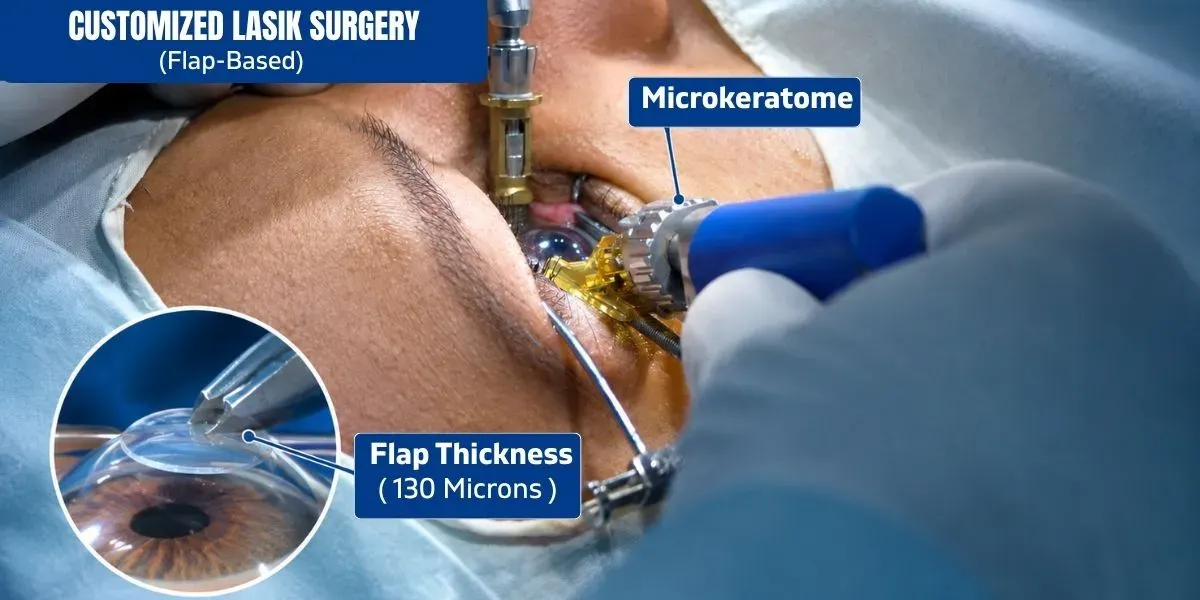 Customized LASIK surgery in Delhi