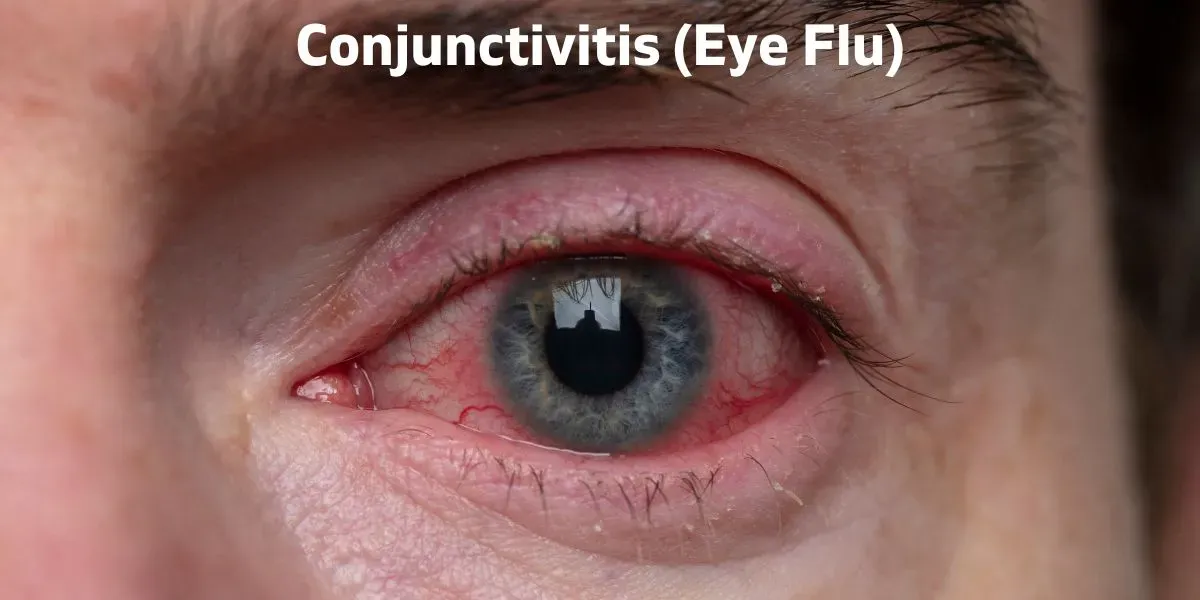 Close-up of a red eye affected by eye flu (conjunctivitis)
