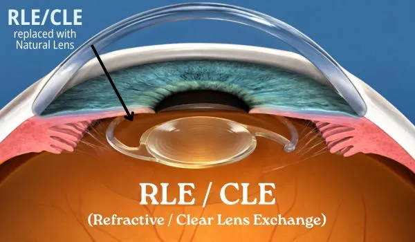 RLE & CLE
