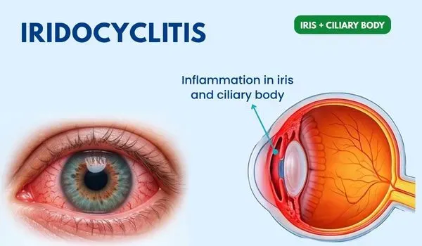 Iridocyclitis