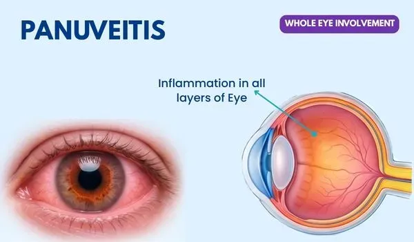 Panuveitis