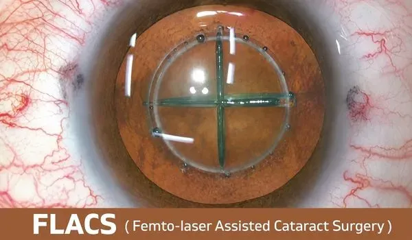 FLACS with Z8 Laser